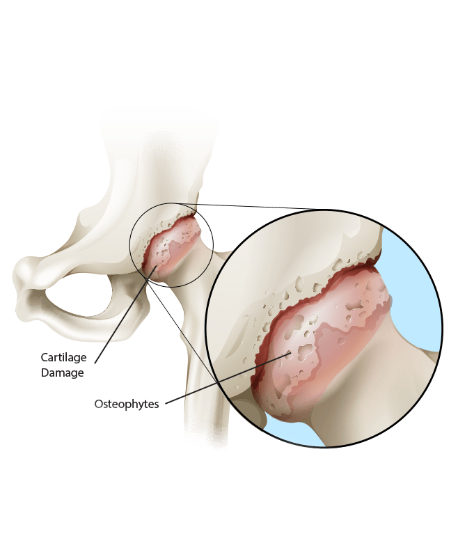 arthritic hip