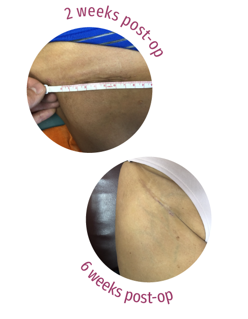 anterior path incision