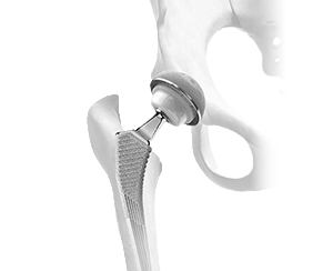 Understanding Total Hip Replacement Hero