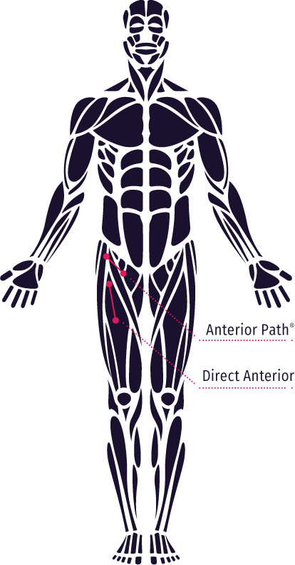 Anterior Path Incision Location