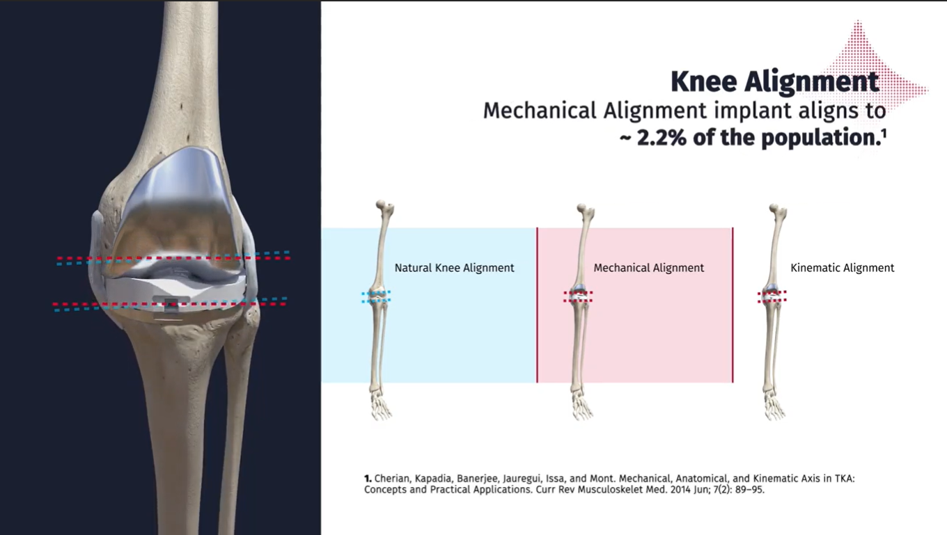 Kinematic Alignment Patient Animation