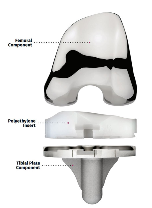 Close up of knee implant