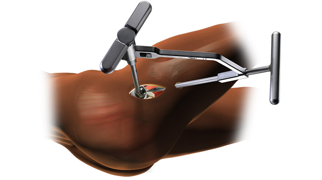 Path Hip Replacement Approach