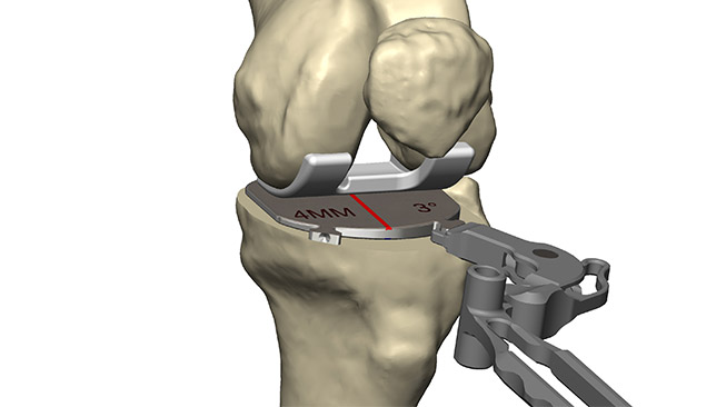 Flexion and Extension Gap Balancing