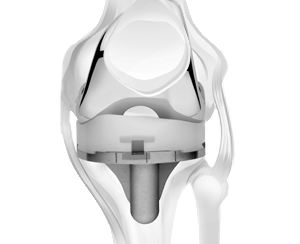 understanding knee replacement